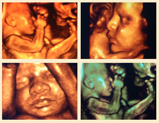 3d live ultrasound